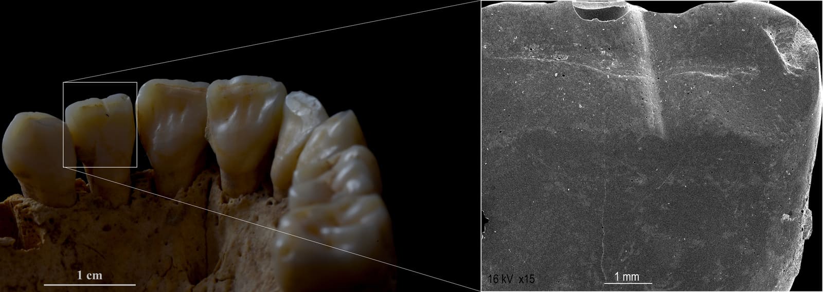 Surco sinfisial en el incisivo de una mujer de Camino del Molino que usaba su dentición para hilado de fibras vegetales. Autoría: Sonia Díaz Navarro
